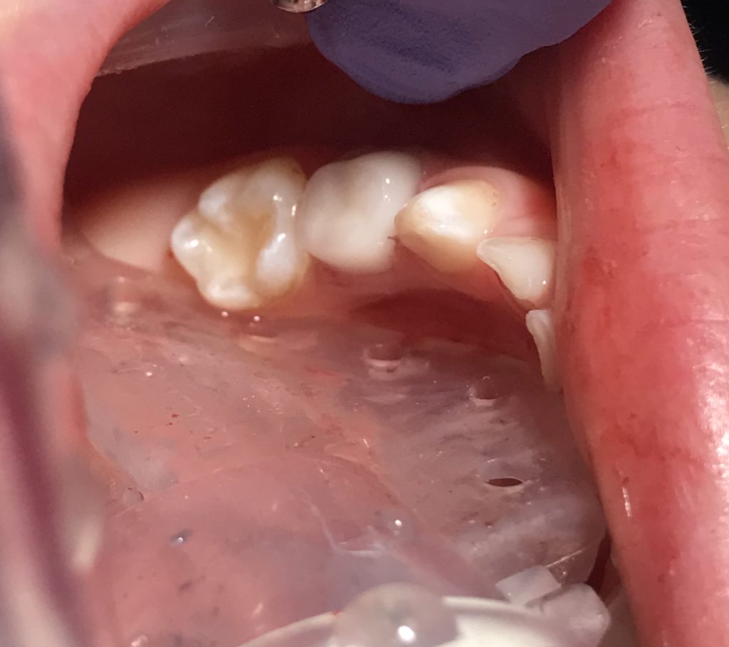 Why Your Child May Need a Dental Crown Dr. Bhaumik DDS