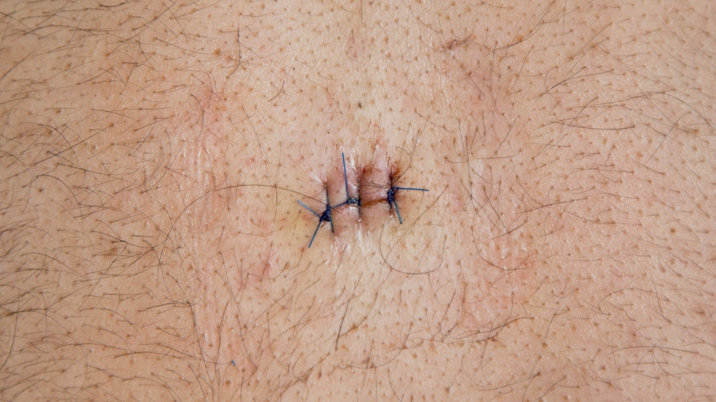What's a Sebaceous Cyst? Signs, Treatments, and What to