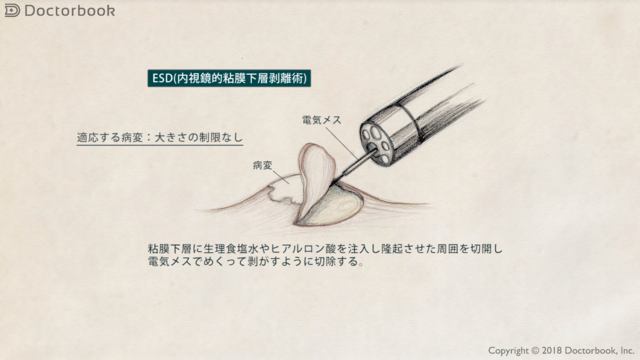 【医師出演】大腸がんの内視鏡治療とは？ESD（内視鏡的粘膜下層剥離術）のメリット・デメリット Doctorbook