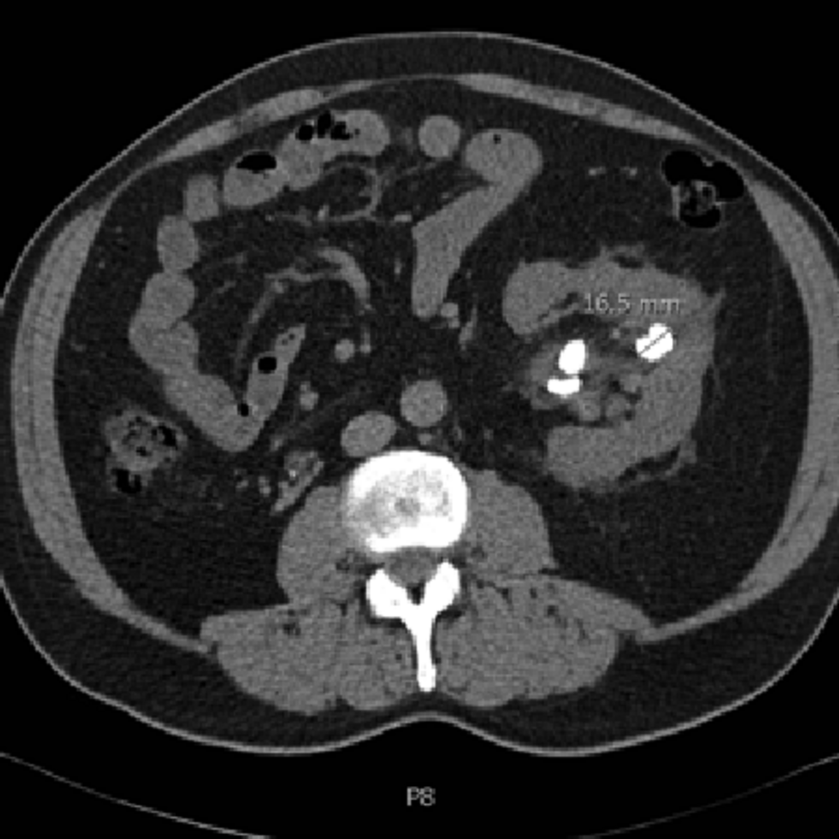 Kidney CT scan Kaggle