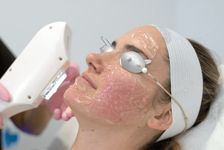 Skin Rejuvenation Summerlin LaserAway