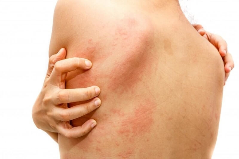 Is Liver Disease Causes Itchy Skin Danger?