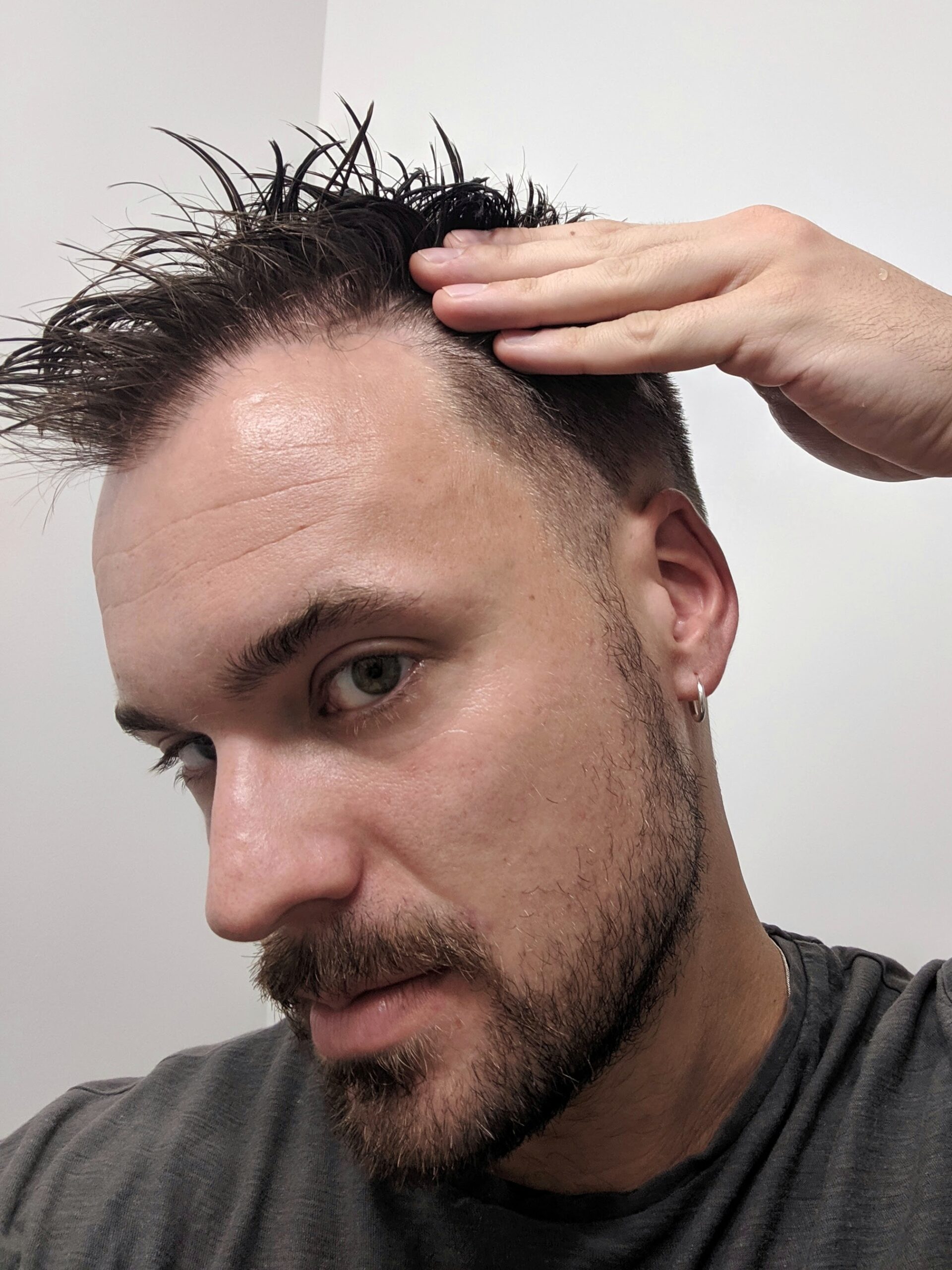 Why This Beauty Editor Got a Hair Transplant At Length Why This Beauty Editor Got a Hair Transplant At Length