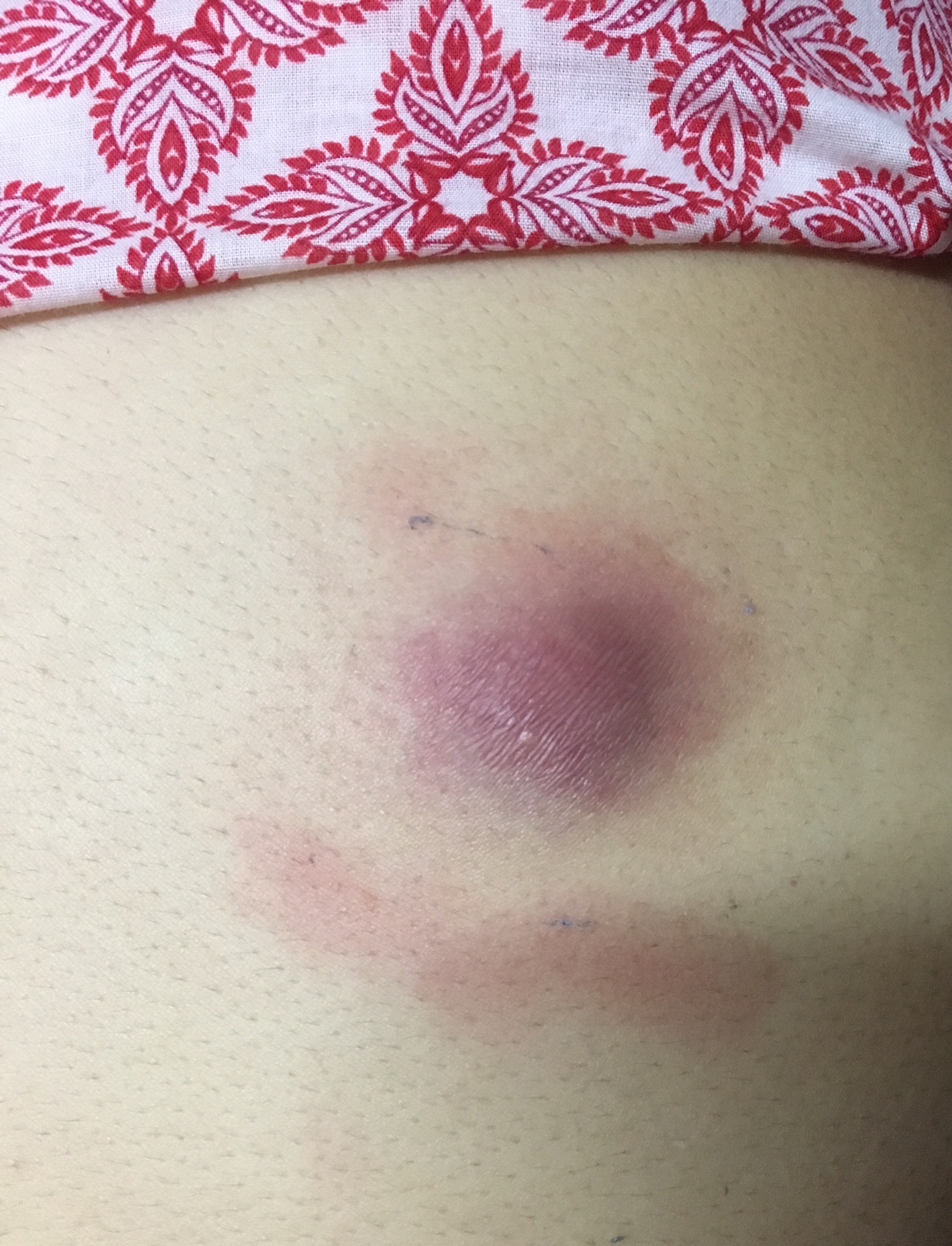 Ask a Dermatologist Online for Pimple Without Head