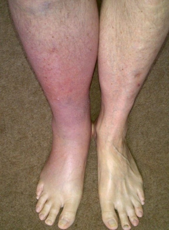 8 Warning Signs Of Blood Clot People Should Be Aware Of Small Joys