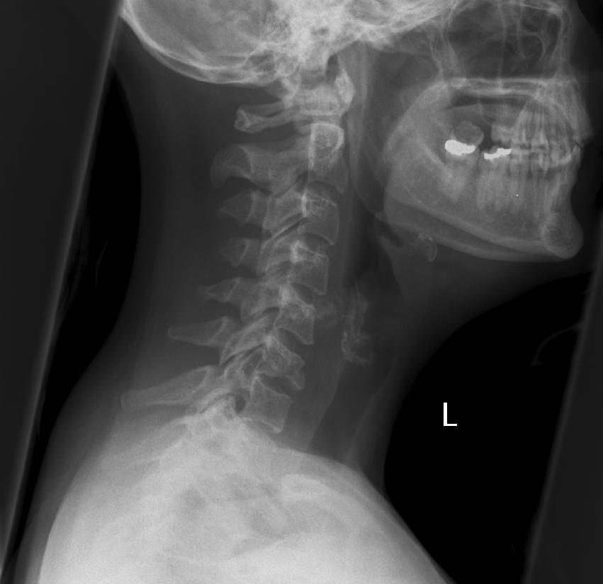Teardrop Fracture radRounds Radiology Network