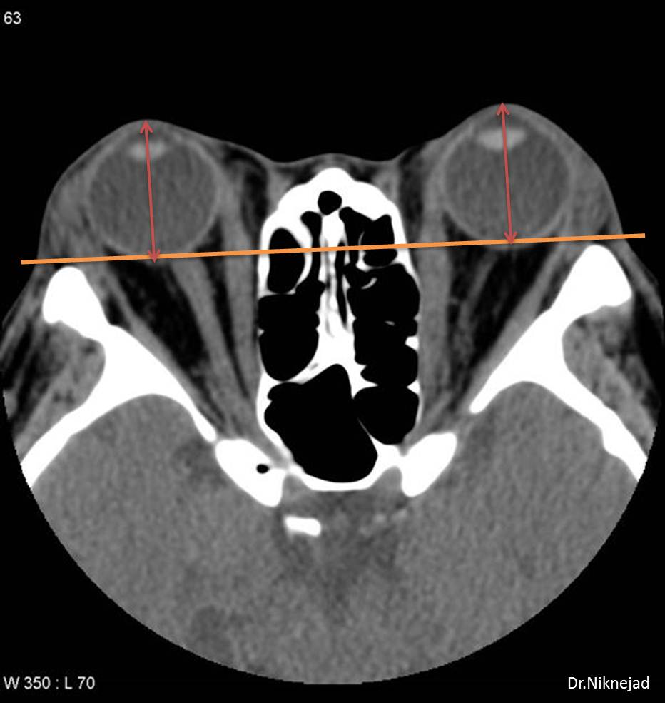 Proptosis & CTscan radRounds Radiology Network
