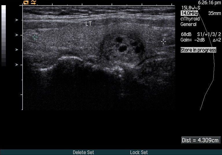 left parathyroid nodule radRounds Radiology Network