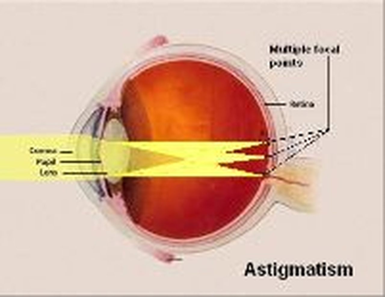 Eye Test Results Astigmatism at Caroline Jackson blog
