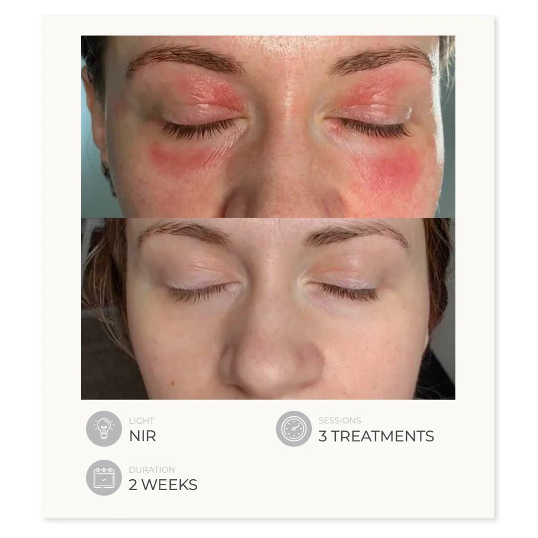 Dermalux Flex MD | By Esteemed Dermalux LED Systems