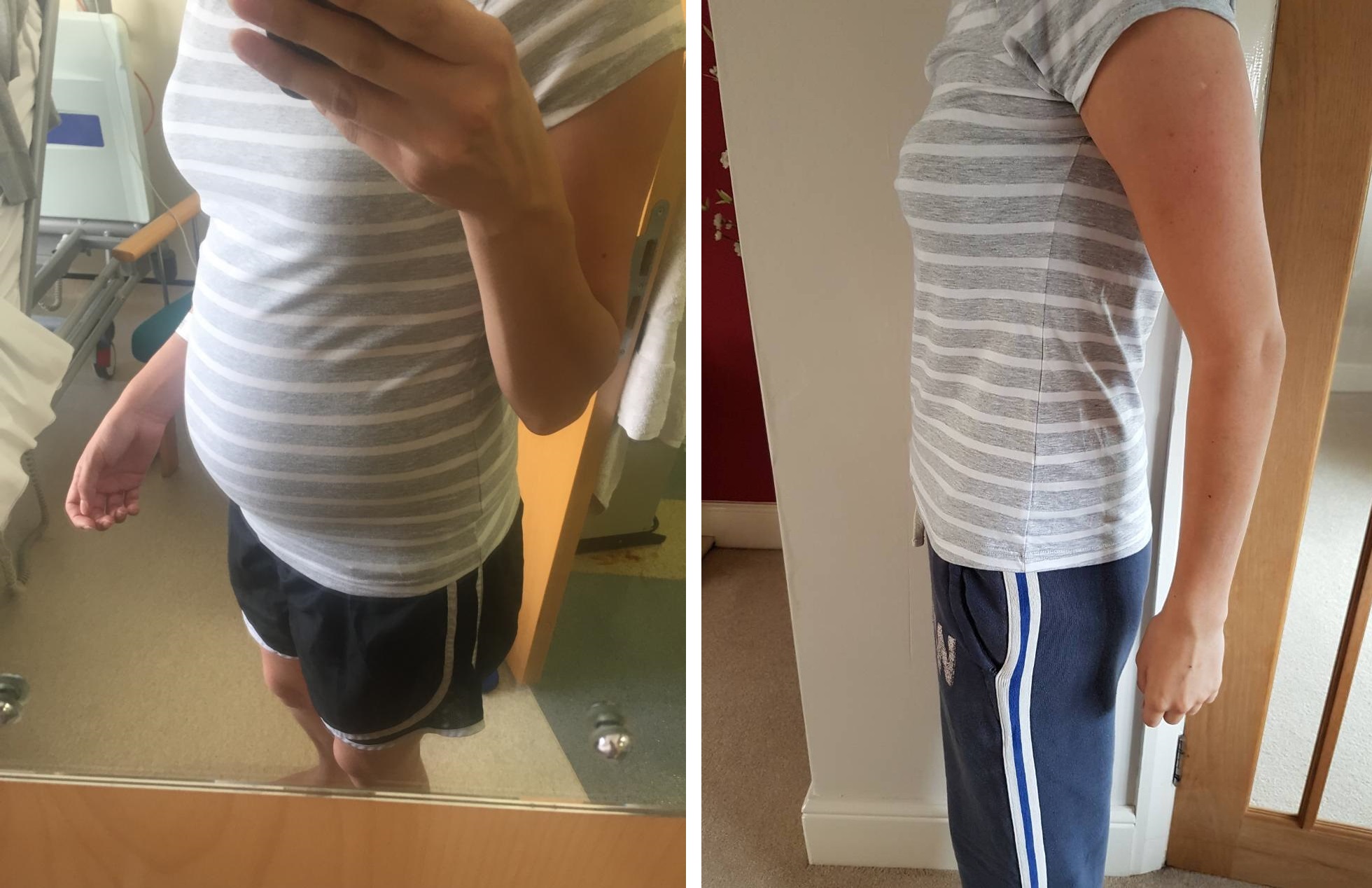 Woman Has Huge Ovarian Cyst Removed After Gym Instructor Asked If She's