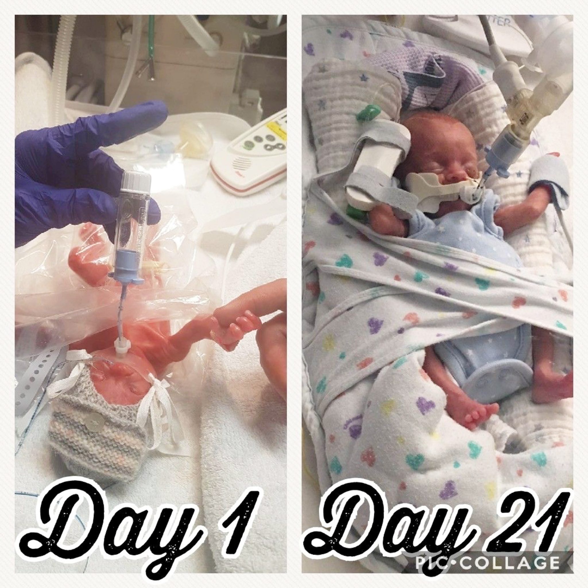 One Of Britain's Most Premature Babies Weighing Just Over 1lb