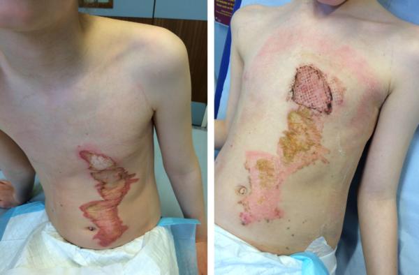 Nineyearold girl scarred for life after filling up hot water bottle