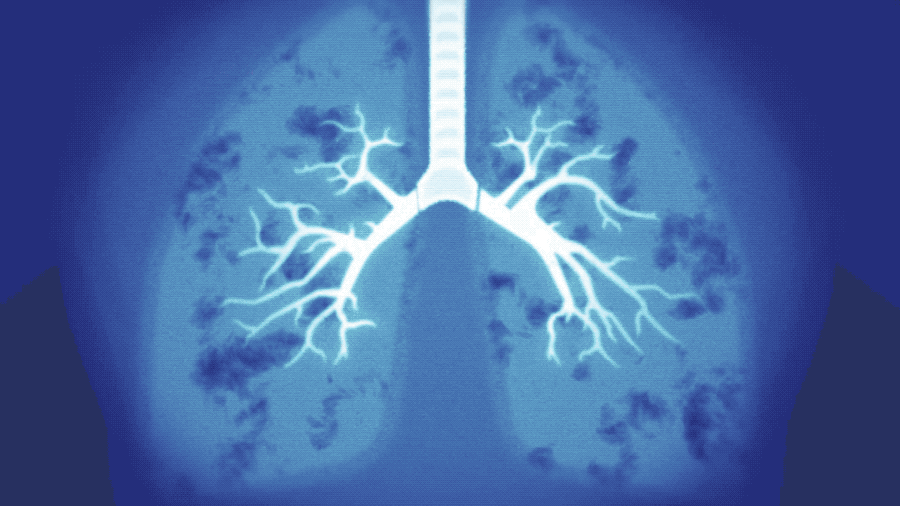 2D animated character video, Covid19 patient interview