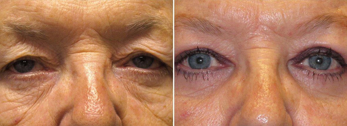 Upper blepharoplasty, lower blepharoplasty, dark circles treatment