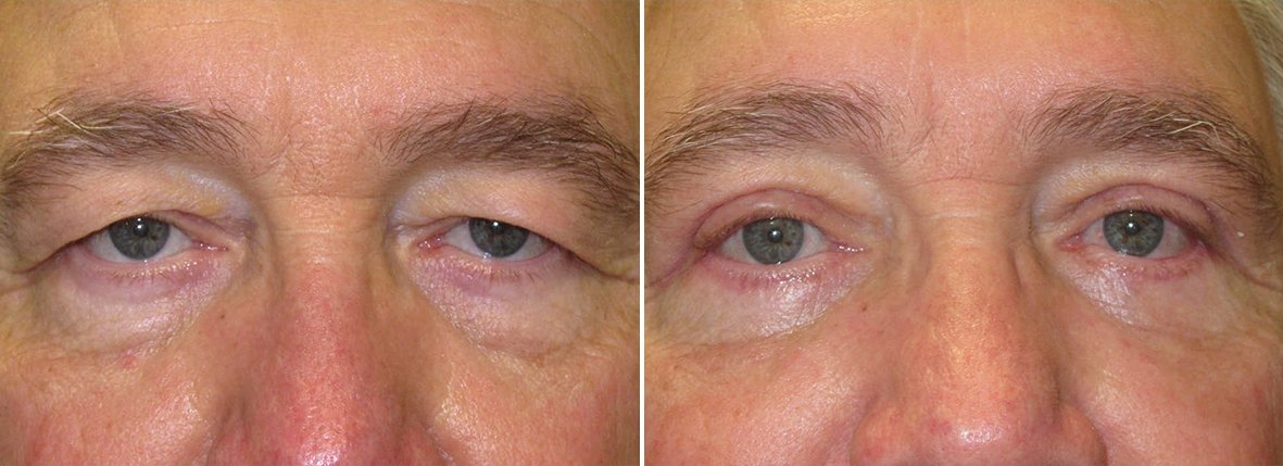 Upper blepharoplasty, lower blepharoplasty, dark circles treatment