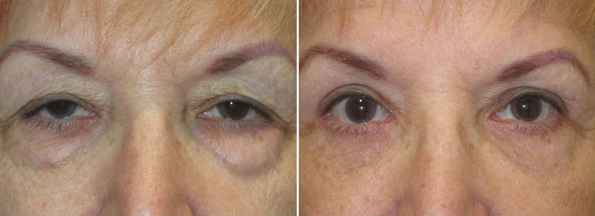 Upper blepharoplasty, lower blepharoplasty, dark circles treatment