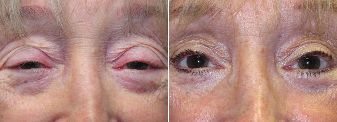 Upper blepharoplasty, lower blepharoplasty, dark circles treatment