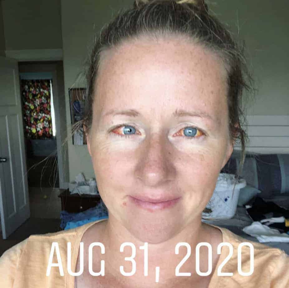 What is Recovery from Strabismus Surgery Like? Daily Details