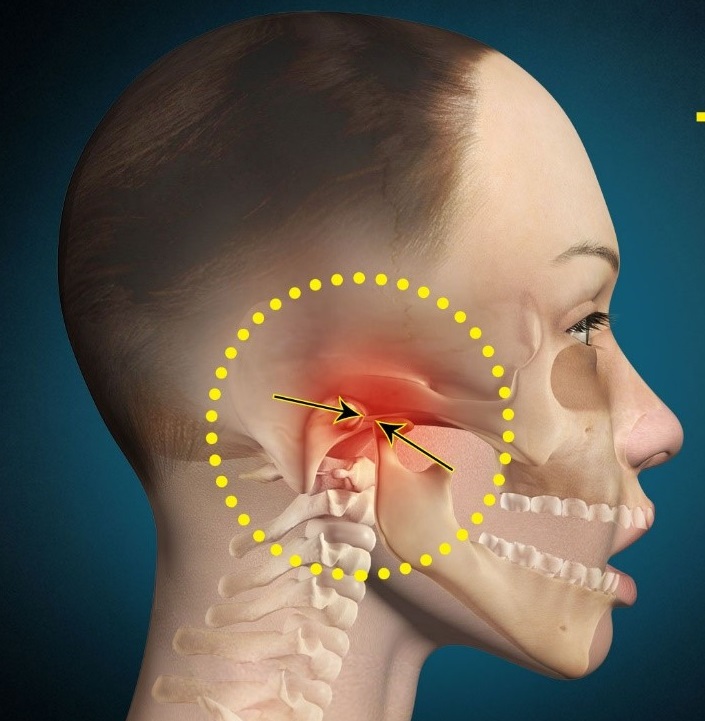 Five signs that suggest you have Temporomandibular disorder(TMD