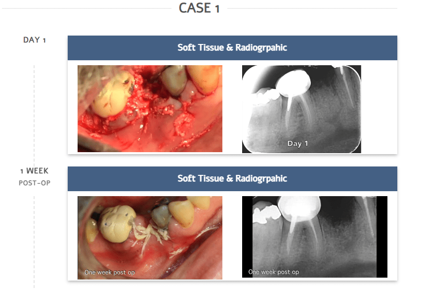 What to Expect Soft Tissue Healing Strauss Diamond
