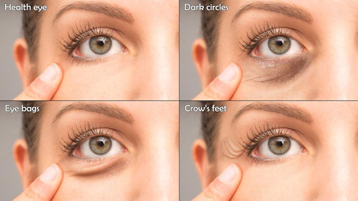 How to Get Rid of Dark Circles Under Eyes