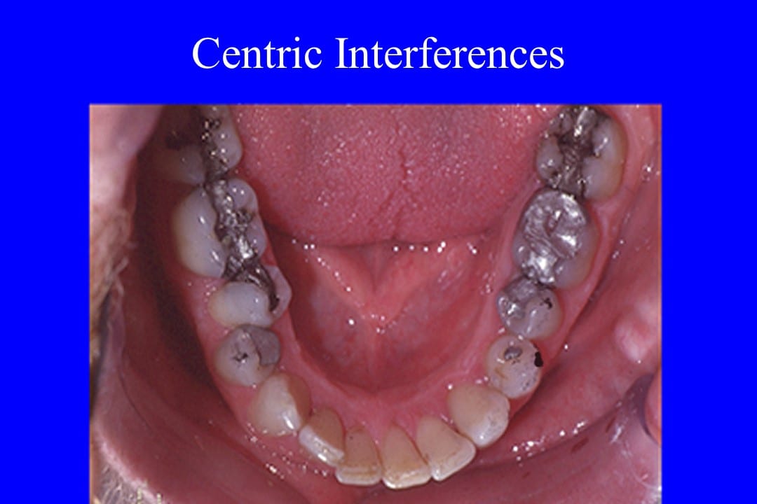 Dental Occlusion Courses A Clinic Occlusal Adjustment Case