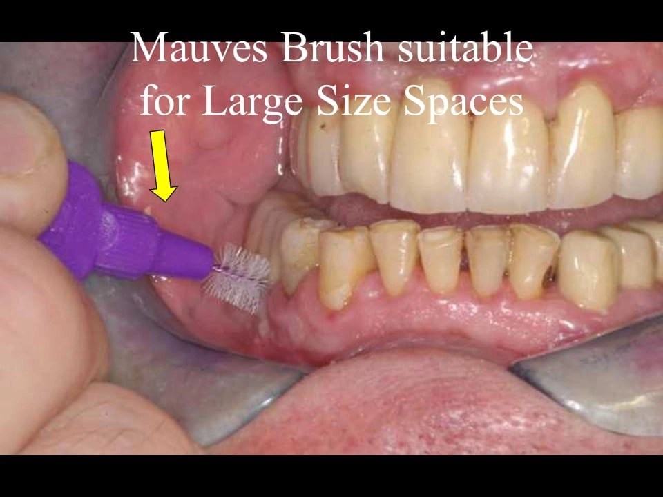 Dental Health Courses Training & Lectures Interdental Brushing