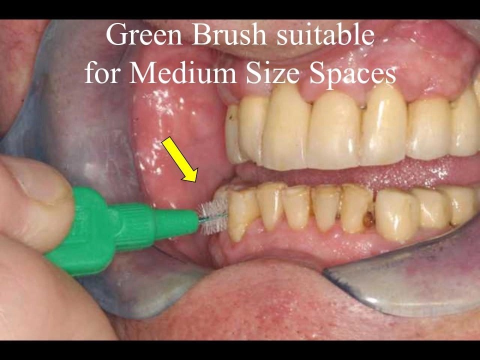 Dental Health Courses Training & Lectures Interdental Brushing