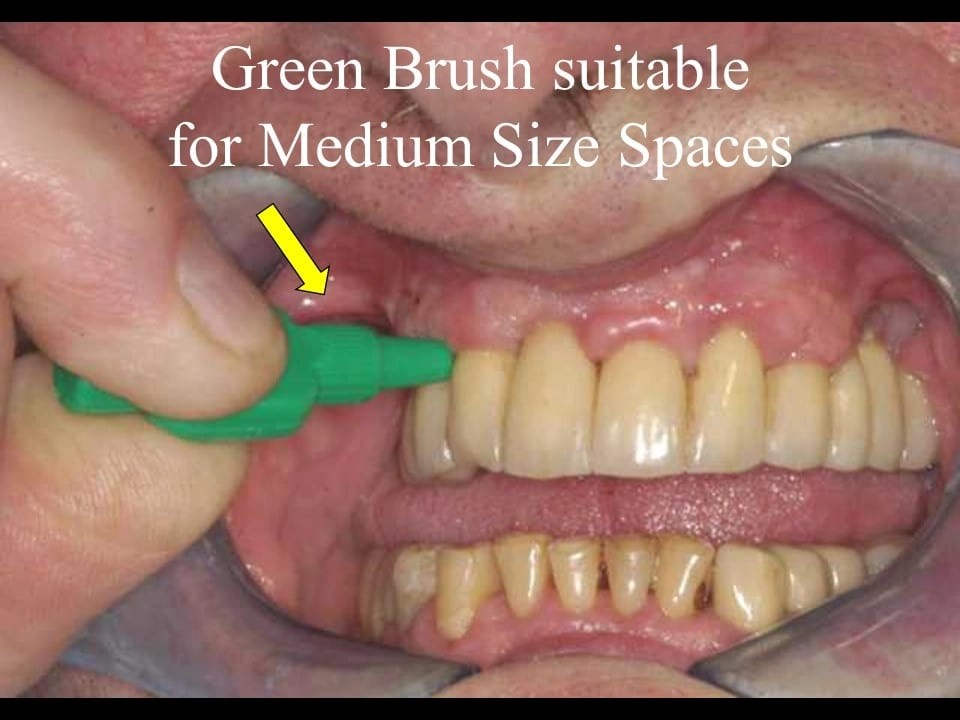 Dental Health Courses Training & Lectures Interdental Brushing