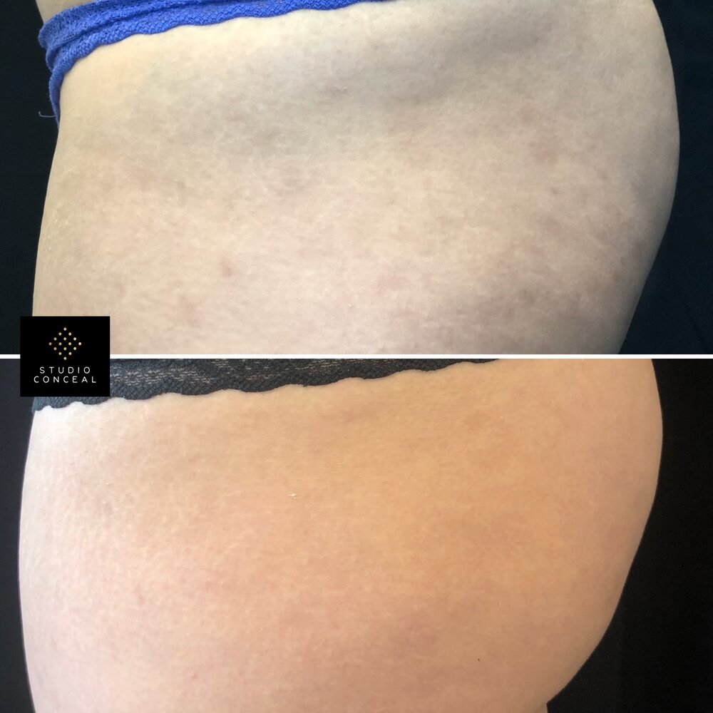 Pictures Of Tattoos That Cover Stretch Marks Can Tattoos Cover