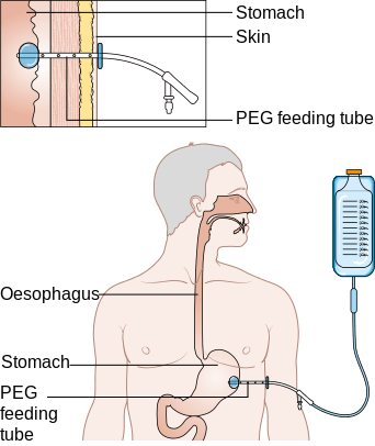 What is a Feeding Tube? - Types & Complications | Study.com
