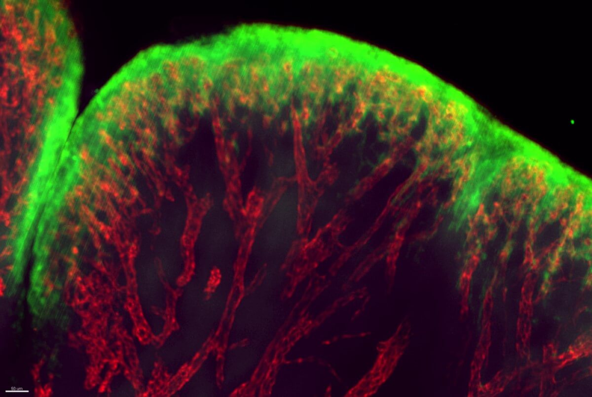 Here's why the cure for arthritis flareups may be treating gum disease