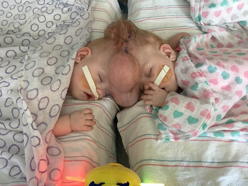 6 years later, rare conjoined twins who survived separation surgery