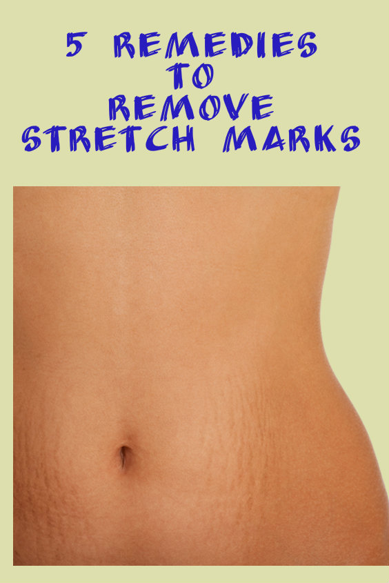 5 remedies to remove Stretch Marks