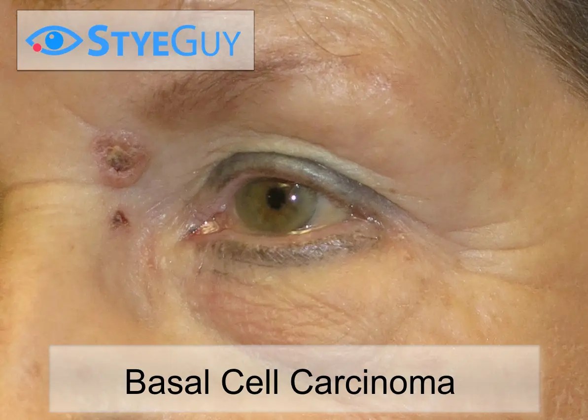 Skin Cancer On Upper Eyelid