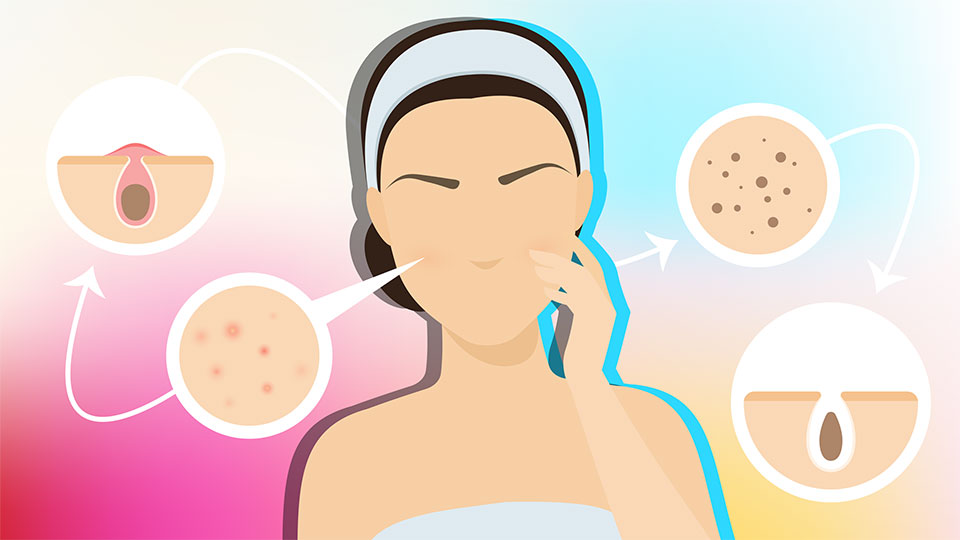 The Stages of a Dark Spot StyleCaster