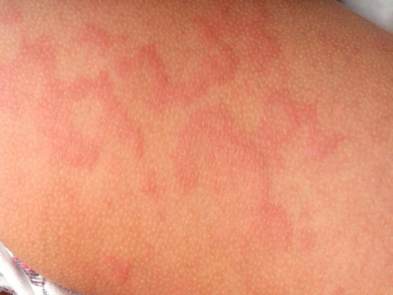 15 Home Remedies To Effectively Treat Diaper Rash Styles At Life