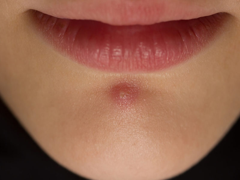 6 Best Home Remedies To Treat Pimples On Chin Styles At Life