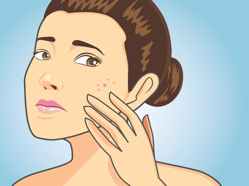 How To Remove Pimples (Acne) In One Day