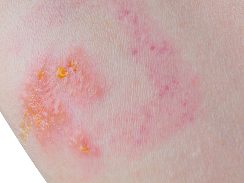 13 Common Skin Rashes That Can Occur to any Body