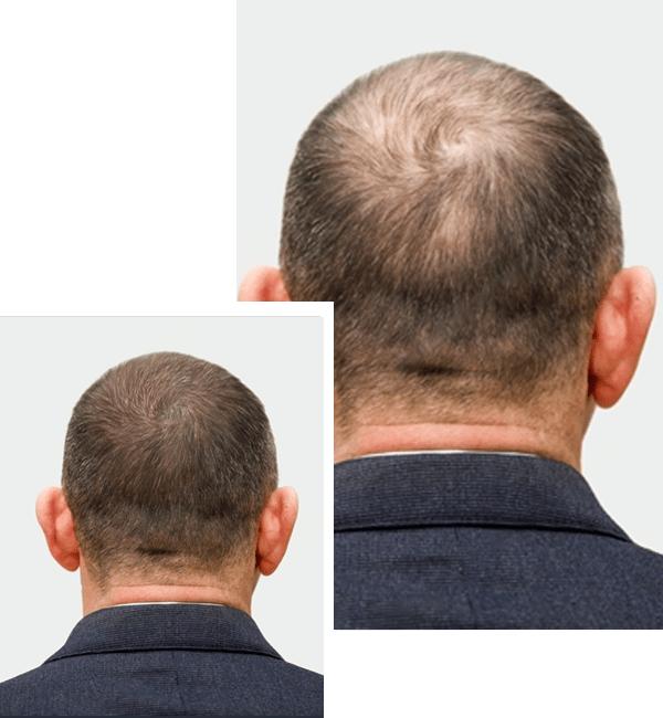 How SMP Compares to Other Hair Loss Solutions? Style Vanity