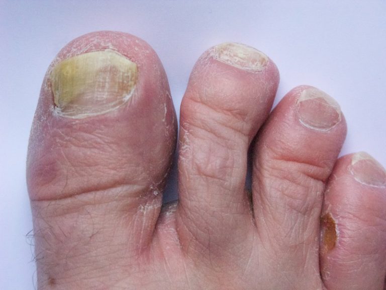 Unhas Amarelas? Quebradiças? Cuidado! Pode ser Micose nas unhas! Dra