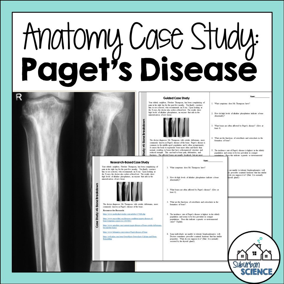 Anatomy Case Studies Paget's Disease Suburban Science