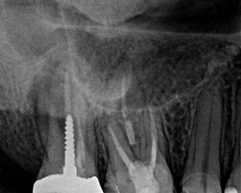 An Endodontic Conventional Retreatment Case… Success in Endodontics
