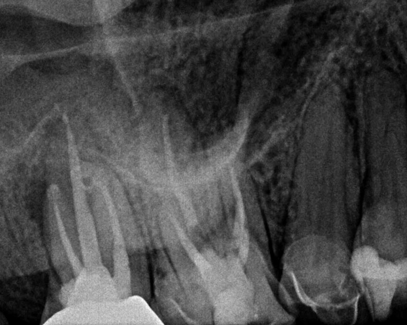 An Endodontic Conventional Retreatment Case… Success in Endodontics