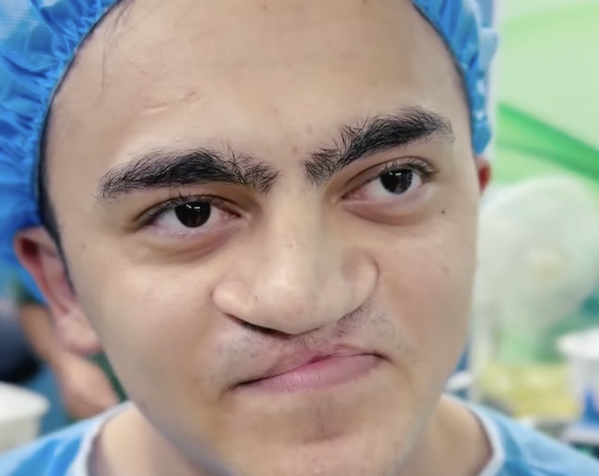 Young Man With Flat and Crooked Nose Gets Surgery And You Won’t Believe