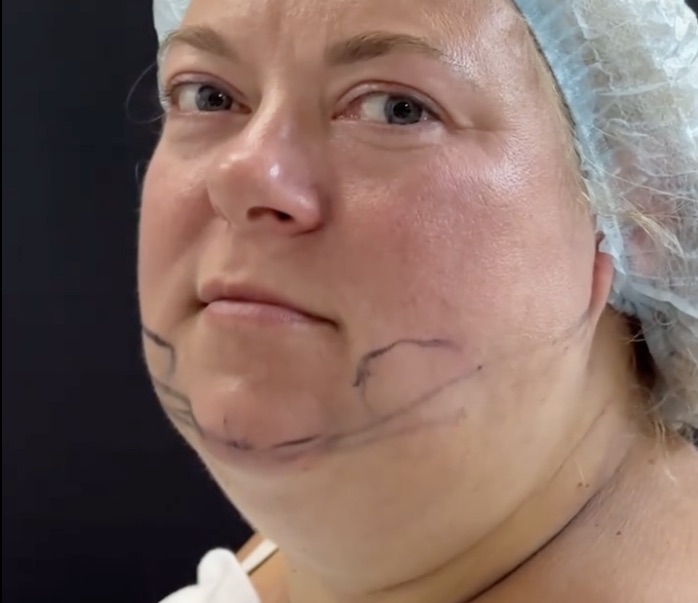 This Young Woman’s Chin Surgery Changed Everything and You Won’t(05)