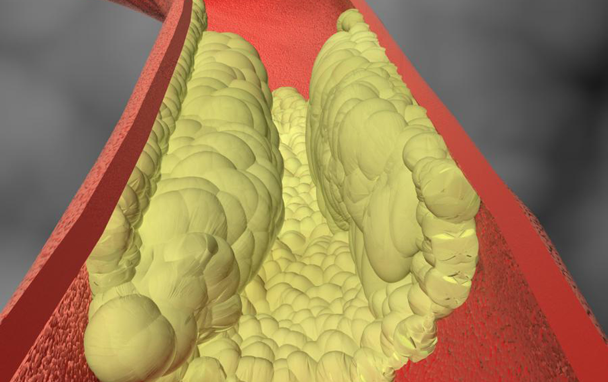 Testing for calcium in the coronary arteries provides better way to