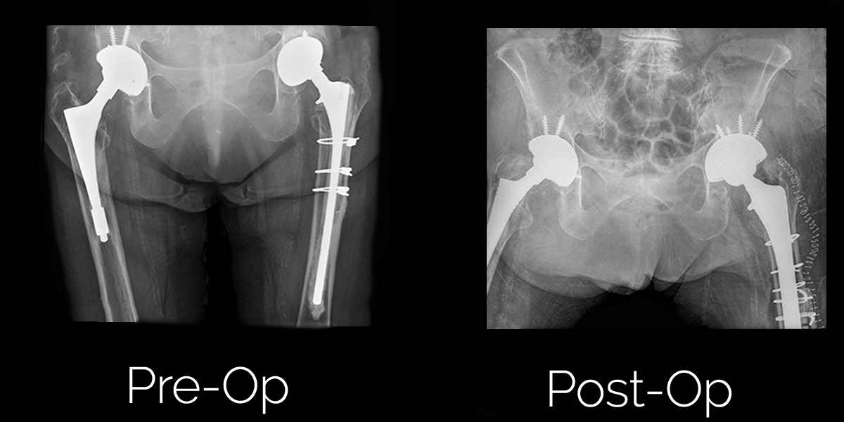 Revision Hip Replacement Sumit Rana, MD